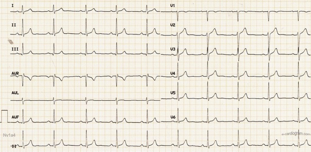 ECG